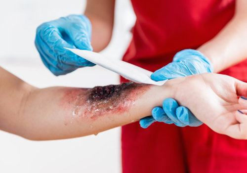 Burn Degree Chart: Spot Burn Severity Fast and Act Right