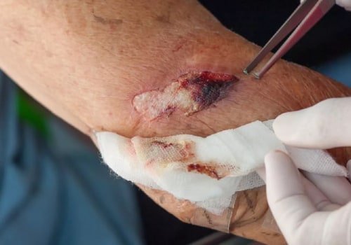 Avoid Serious Complications: How to Tell If a Cut Is Infected or Healing